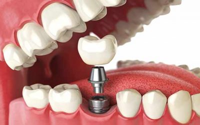 A Dental Implant Can Completely Restore One of Your Lost Teeth