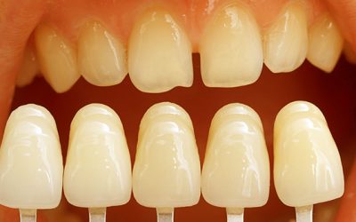 What Can Dental Veneers Do for You