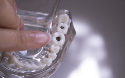 A Partial Can Replace the Lost Function of Multiple Missing Teeth